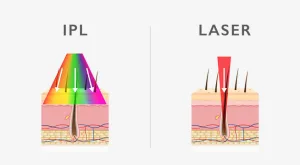 Perbedaan IPL dan Laser Hair Removal 