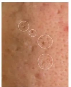Ice Pick Scar