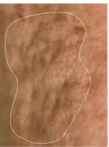 Rolling Scar