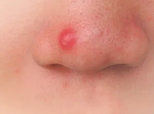 Jerawat Batu di Hidung