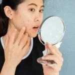 Cara Menghilangkan Jerawat Hormon dan Mengurangi Risiko Kambuh