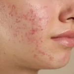 Jerawat Hormonal: Ciri-Ciri, Penyebab, dan Cara Mengatasinya