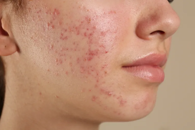 Jerawat Hormonal: Ciri-Ciri, Penyebab, dan Cara Mengatasinya
