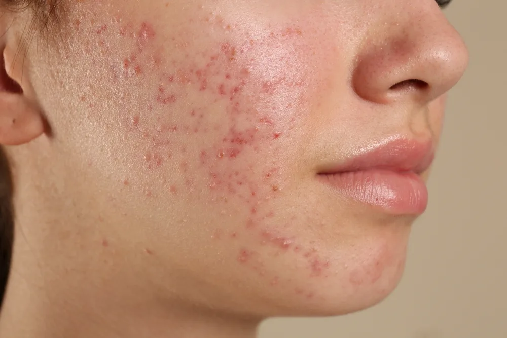 Jerawat Hormonal: Ciri-Ciri, Penyebab, dan Cara Mengatasinya