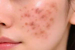 Post-Inflammatory Erythema (PIE)
