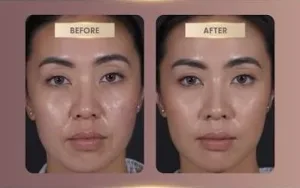 Hasil Juvelook Treatment