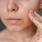 Wajah Berminyak dan Berjerawat? Ini Treatment Klinik yang Bisa Kamu Pertimbangkan