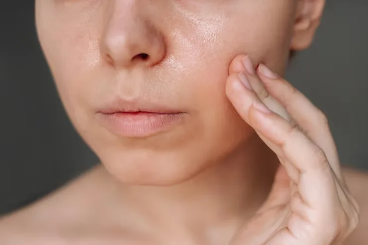 Wajah Berminyak dan Berjerawat? Ini Treatment Klinik yang Bisa Kamu Pertimbangkan