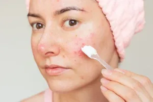 Skincare Pemicu Iritasi
