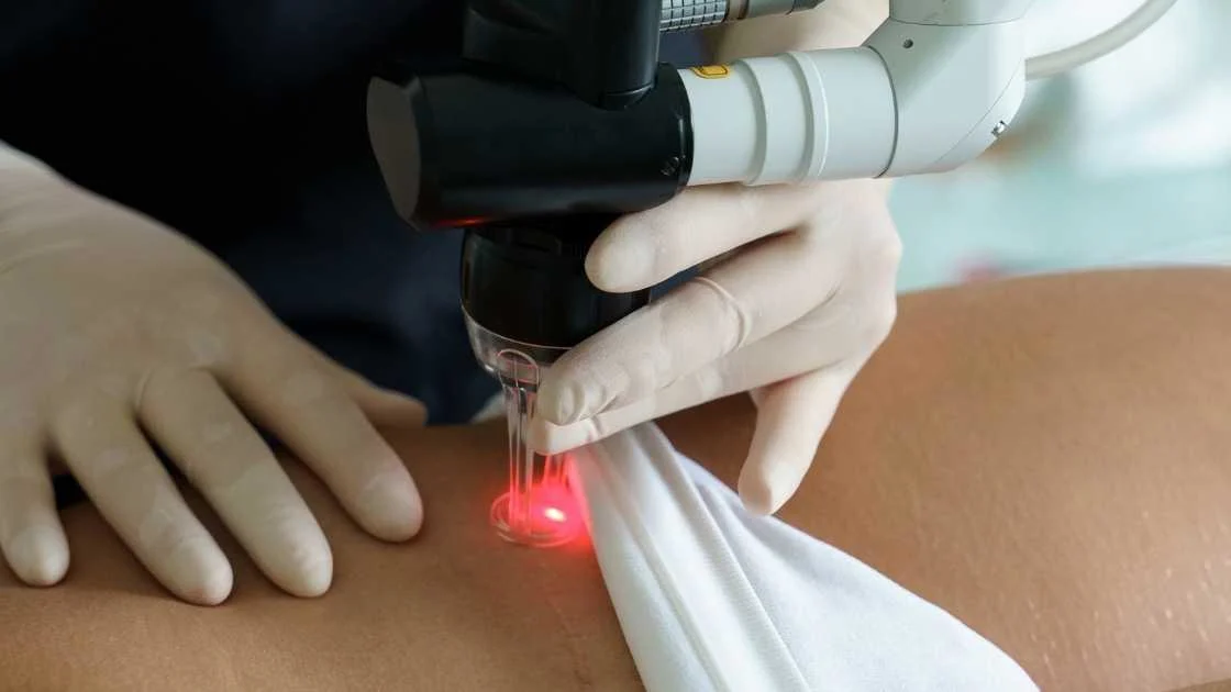 Laser Bekas Luka: Seberapa Efektif, dan Kapan Sebaiknya Mulai?