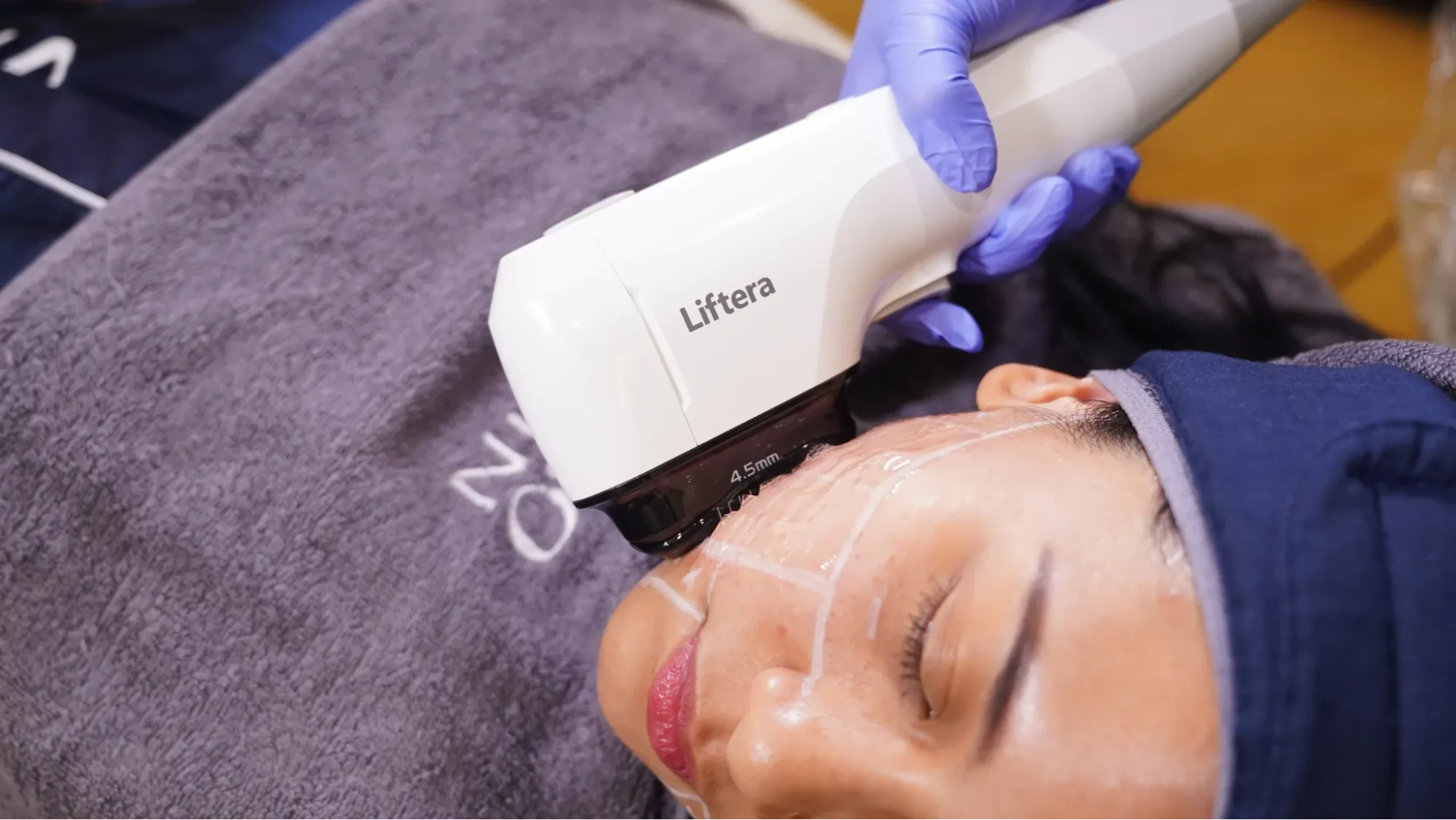 Liftera HIFU: Apa Bedanya dengan HIFU Lain?
