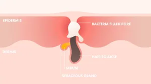 Ilustrasi Sebum