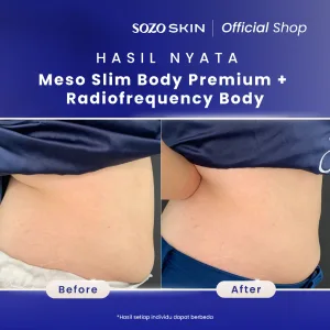 Hasil Meso Treatment