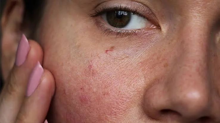 Over-Exfoliation