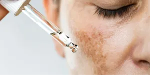 Skincare untuk Pencegahan Flek Hitam