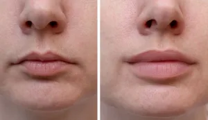 perawatan filler bibir