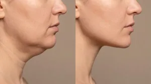 perawatan meso double chin
