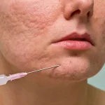 Subsisi vs Skin Booster, Mana yang Kamu Butuhkan?
