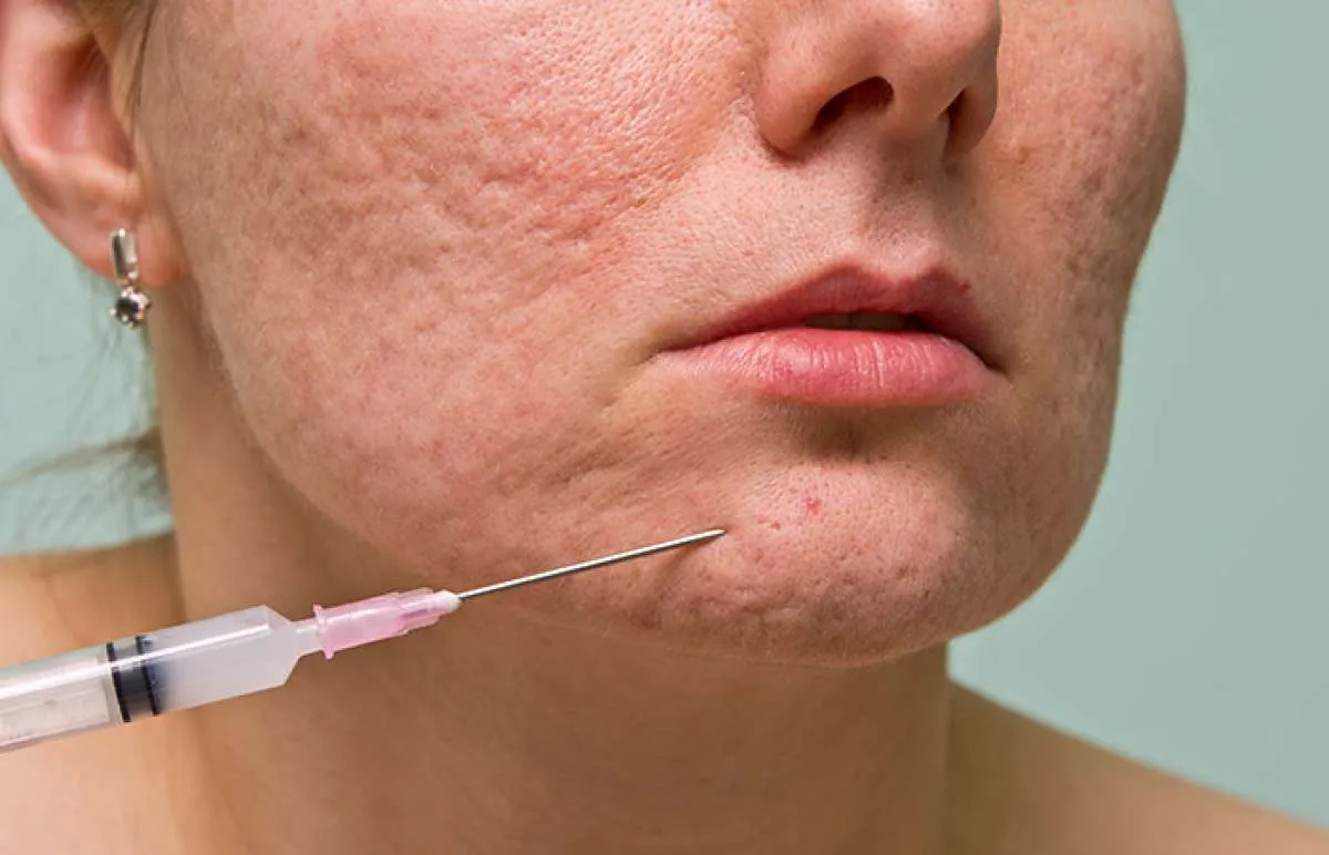 Subsisi vs Skin Booster, Mana yang Kamu Butuhkan?