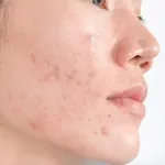 PIH Adalah Bekas Hitam Setelah Jerawat? Kenali Penyebab dan Cara Mengatasinya