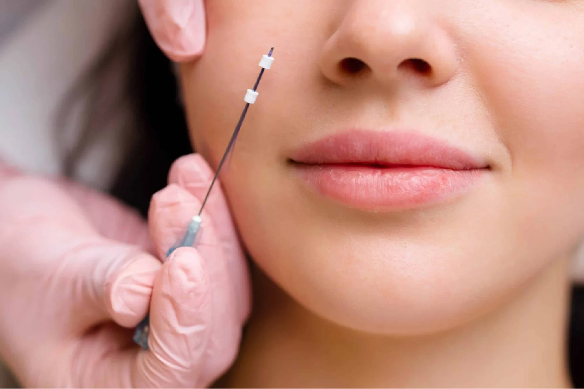 Tarik Benang Hidung: Manfaat, Prosedur, dan Berapa Lama Hasilnya Bertahan?