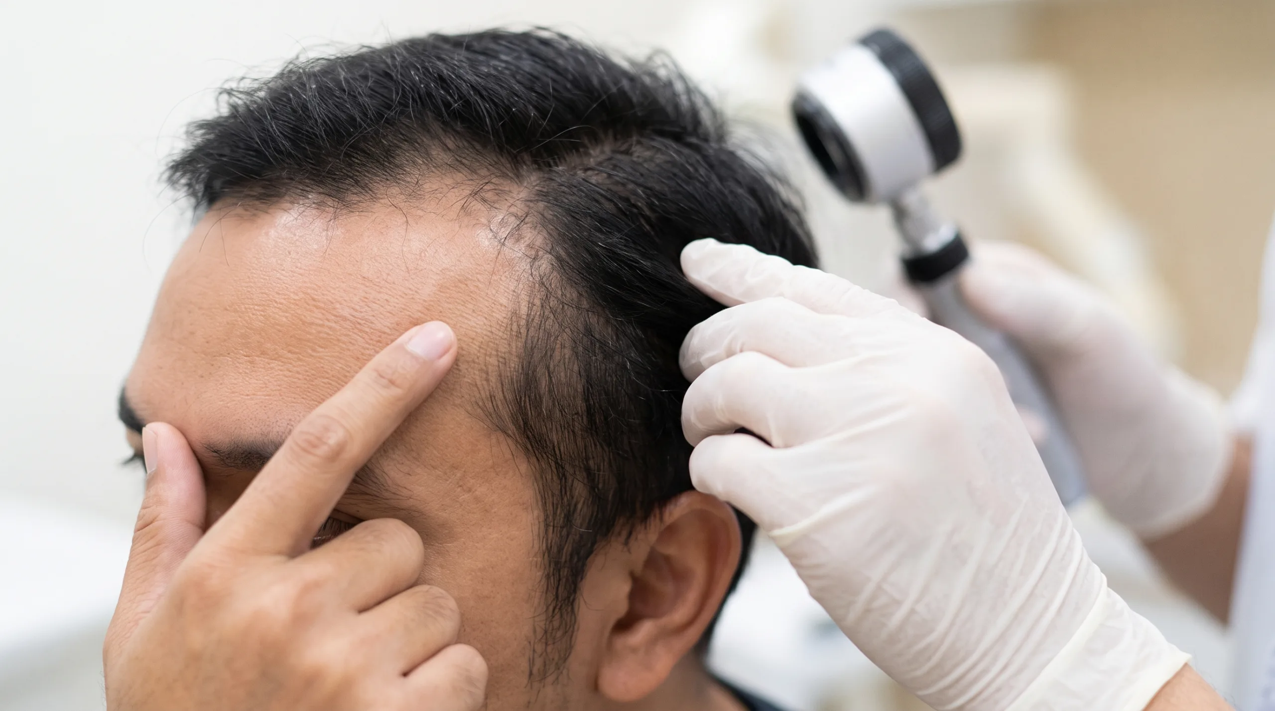Garis Rambut Mundur, Bisakah Dibantu PRP Rambut?