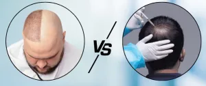 Perbedaan PRP vs Tanam Rambut