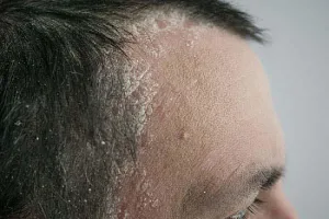 Psoriasis Rambut
