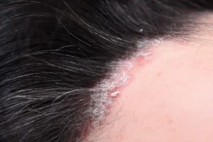 Psoriasis Rambut Kambuh 