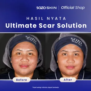 Hasil Scar Treatment