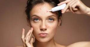 Pemakaian Skincare pada Jerawat