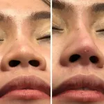 Efek Samping Tanam Benang Hidung yang Perlu Kamu Tahu Sebelum dan Sesudah Treatment