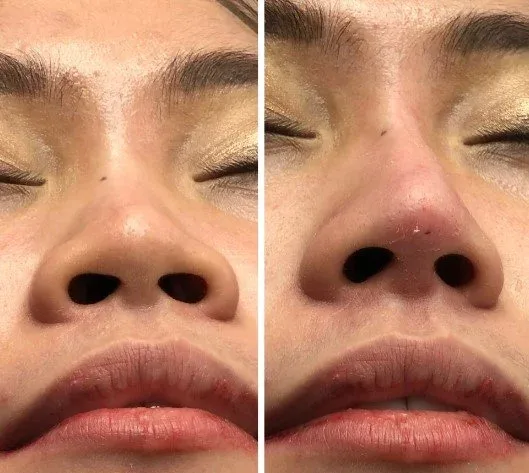 Efek Samping Tanam Benang Hidung yang Perlu Kamu Tahu Sebelum dan Sesudah Treatment