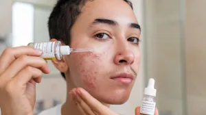 Pemakaian Serum Jerawat