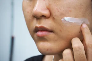 Ilustrasi Skincare pada Bekas Jerawat 