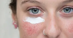 Pemakaian Skincare setelah Iritasi