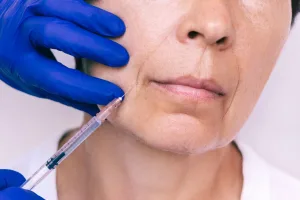 Filler untuk Smile Lines