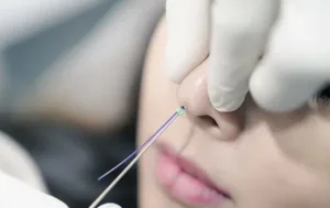 Tanam Benang Hidung