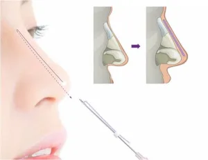 Ilustrasi Cara Kerja Tarik Benang Hidung