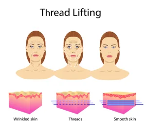 Prosedur Threadlift