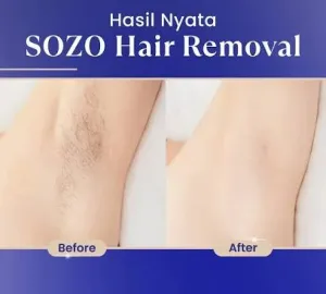 Hasil IPL Hair Removal